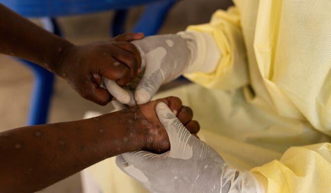 Africa’s CDC declares mpox a public health emergency