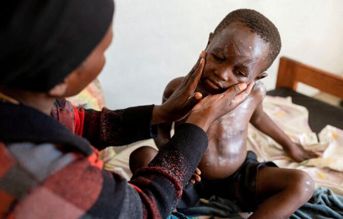 There is an mpox jab. Why is it taking so long to reach Africa?