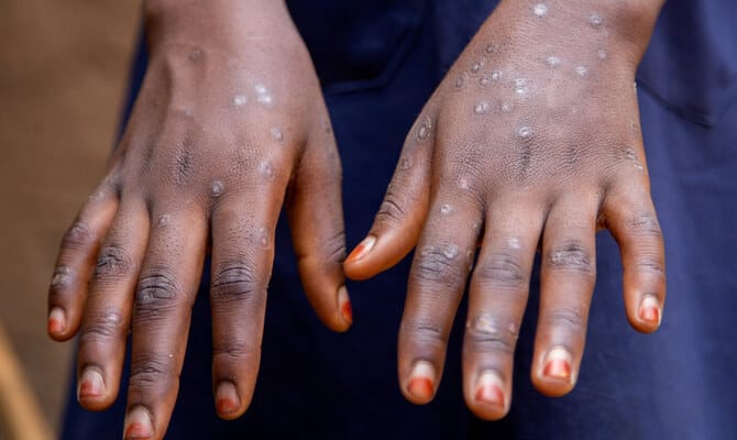 UNICEF issues emergency tender to secure mpox vaccines