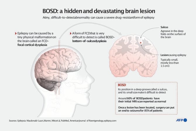 AI tool helps researchers treat child epilepsy